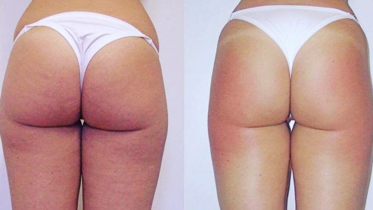 Resultados tratamientos body contourning